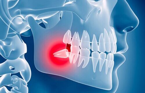 extraction dent de sagesse tunisie