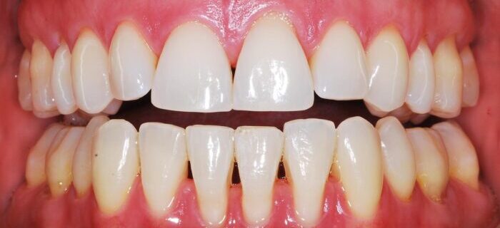 traitement-recession-gingivale-tunisie
