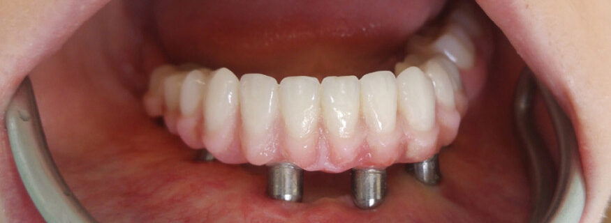 prothese maxillo facial dentaire