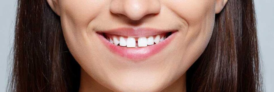 diastème espace entre dents