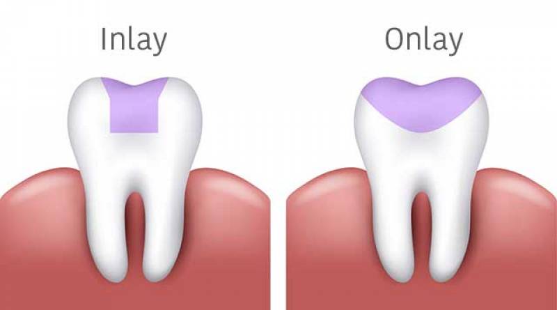 inlay onlay couronne