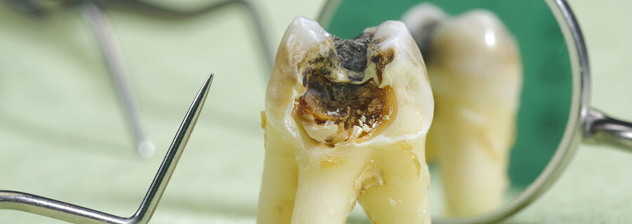 traitement dents noires