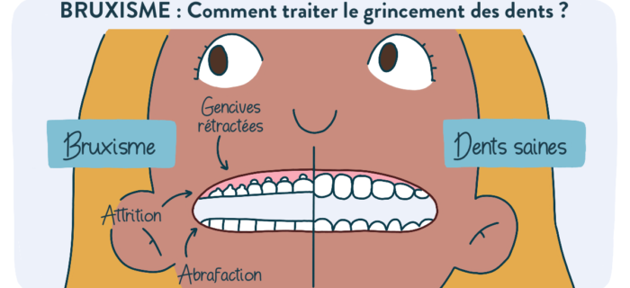 traitement botox au grincement et bruxisme tunisie