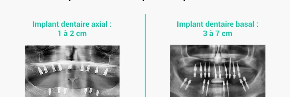 implant dentaire basal