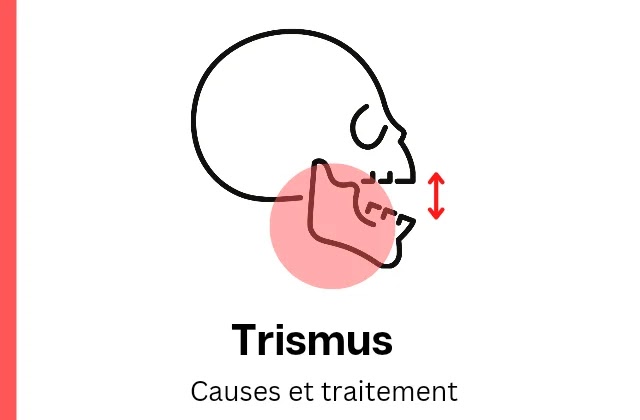 Causes et traitements du trismus