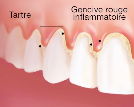 tartre