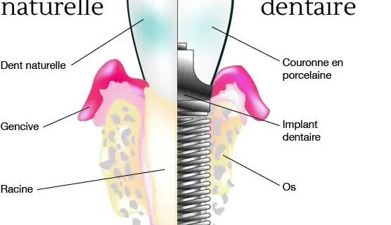 dent naturelle vs implant
