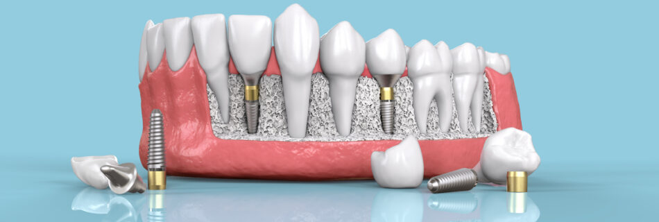 espace interdentaire sur implant all in 4