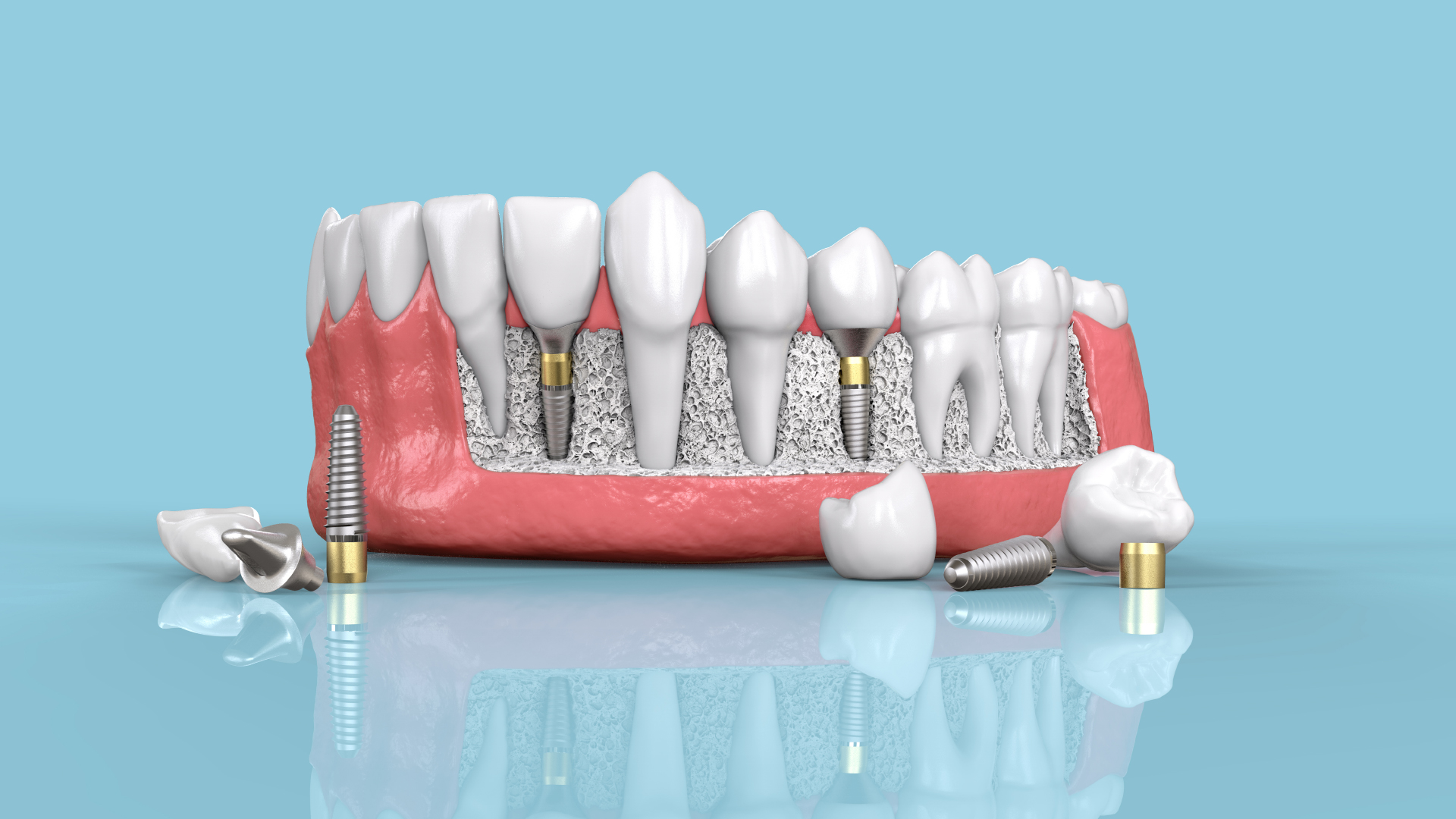 espace interdentaire sur implant all in 4