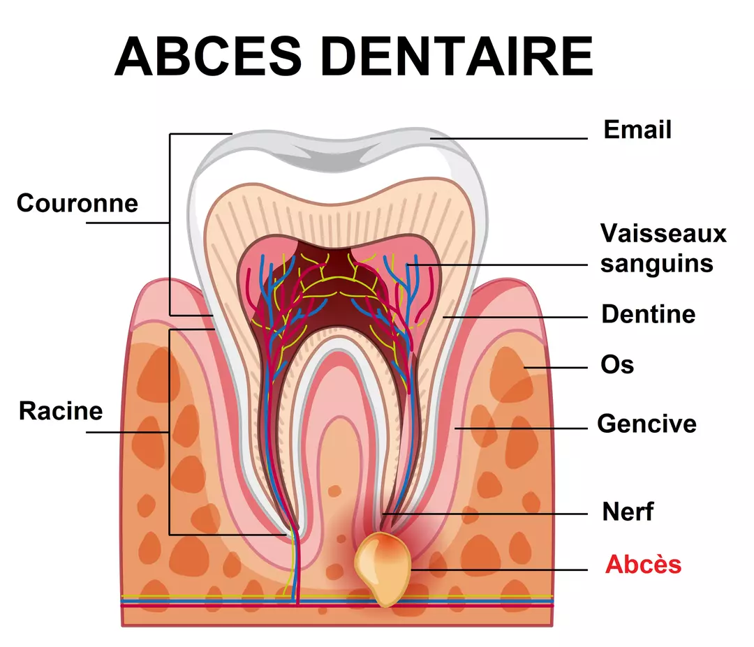 abces dentaire traitement