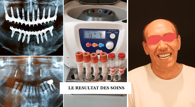 Croissance osseuse dentaire par PRF