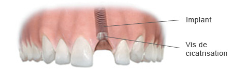 cicatrisation implant dentaire