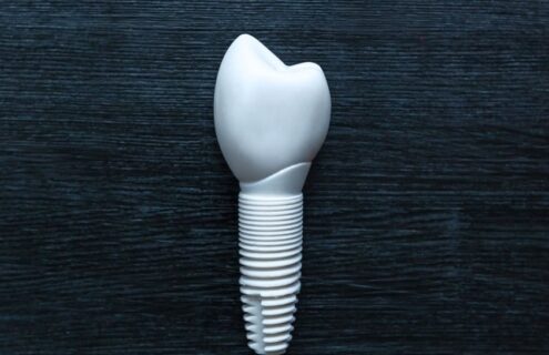 implant dentaire en zircone