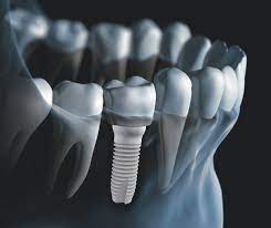 implant dentaire titane