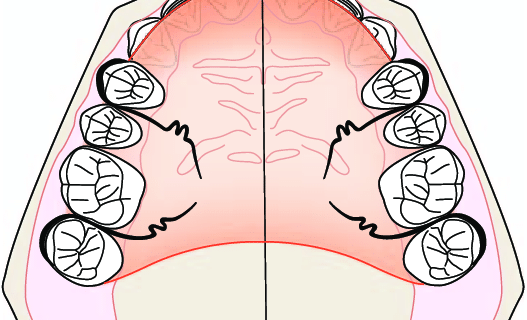 morsure chirurgie orthognatique