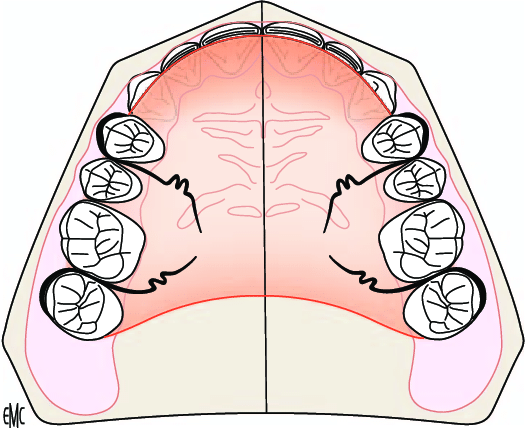 morsure chirurgie orthognatique