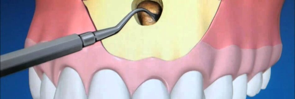 chirurgie d'apicoectomie