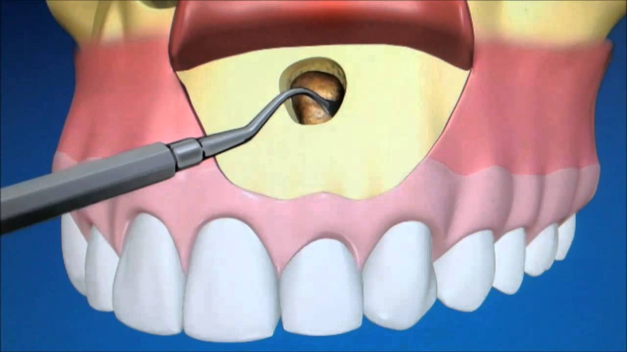 chirurgie d'apicoectomie
