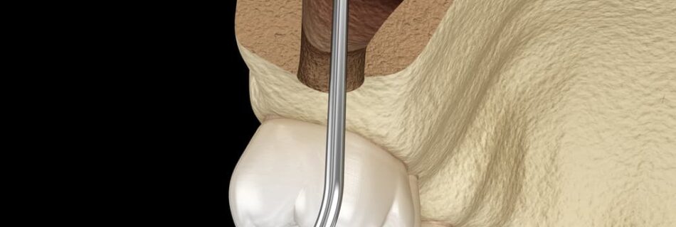 sinus lift implant