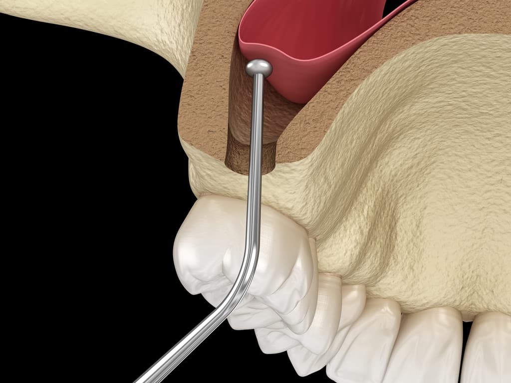 sinus lift implant