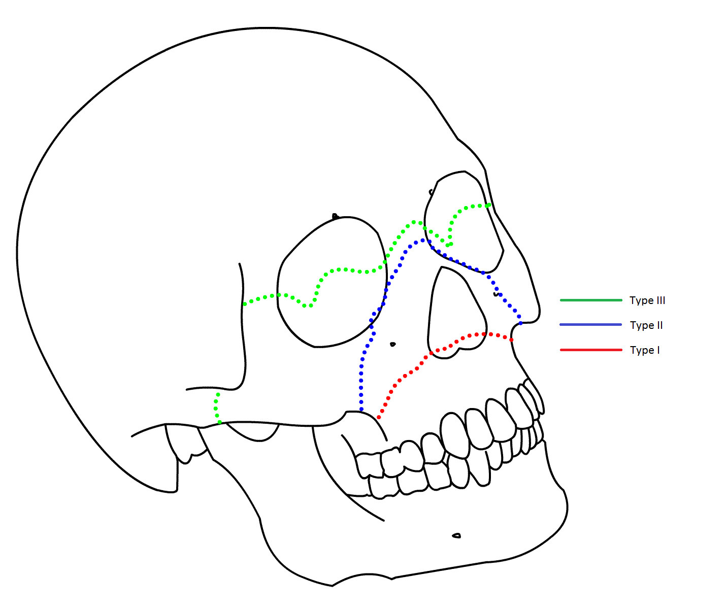 traumatisme facial