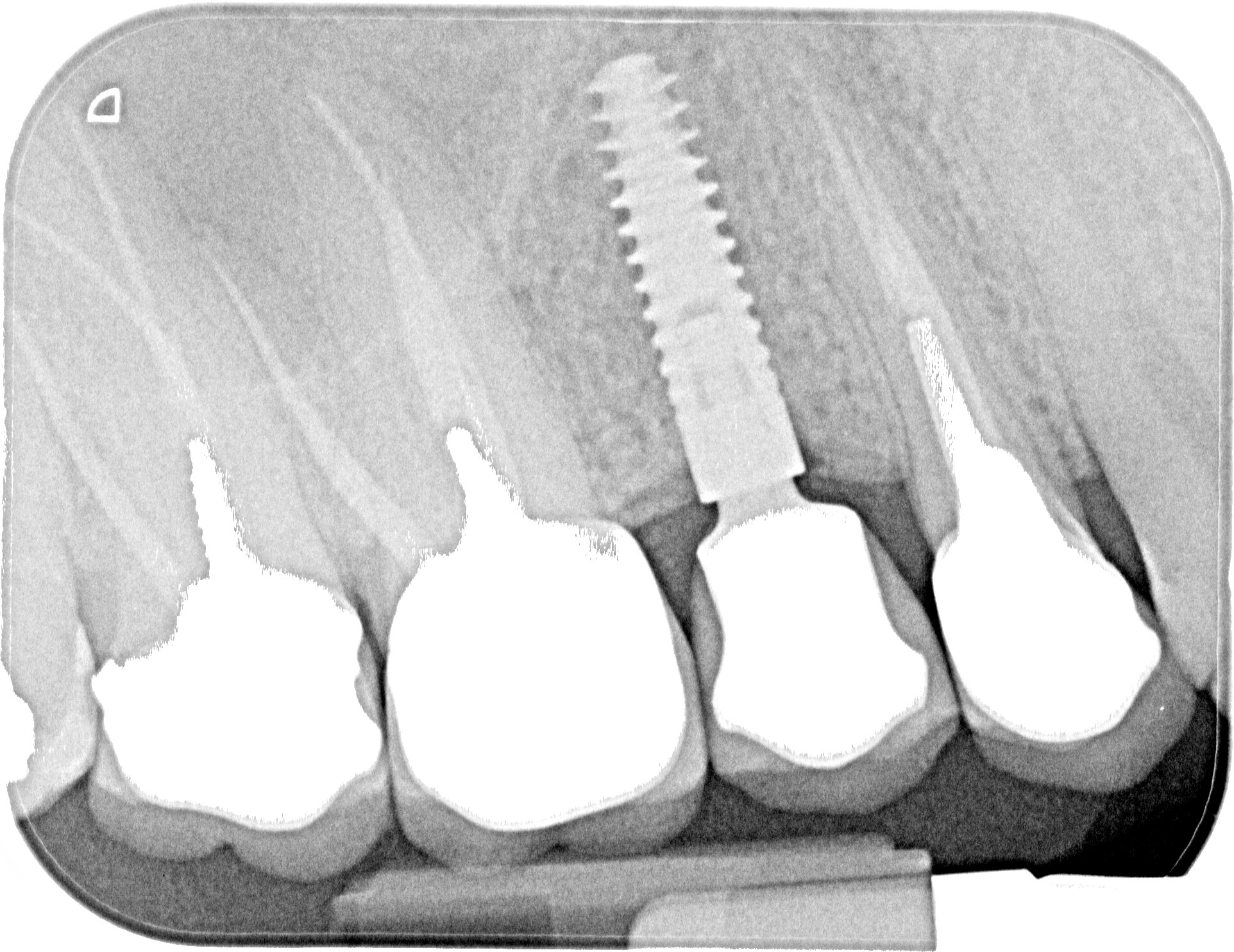 complications implants dentaires