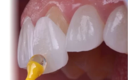 prix facette veneers tunisie
