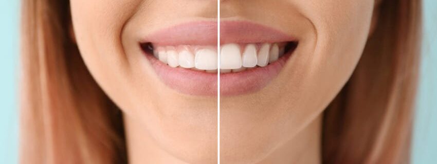prix gingivectomie tunisie