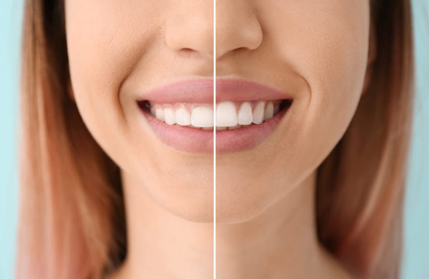 prix gingivectomie tunisie
