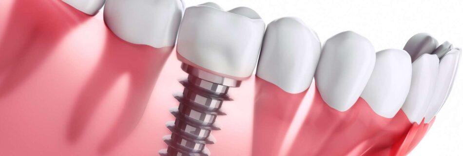 prix implant dentaire tunisie