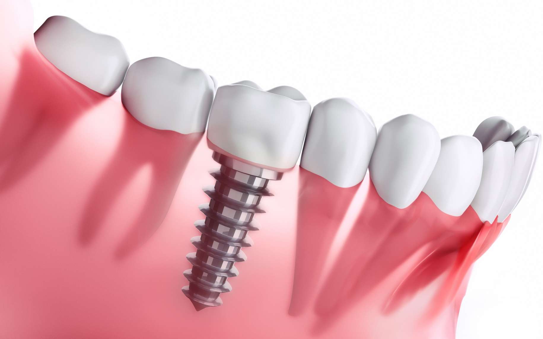 prix implant dentaire tunisie