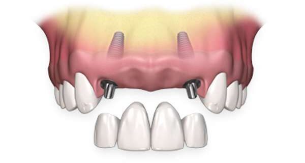 4 dents de devant cassees couronne