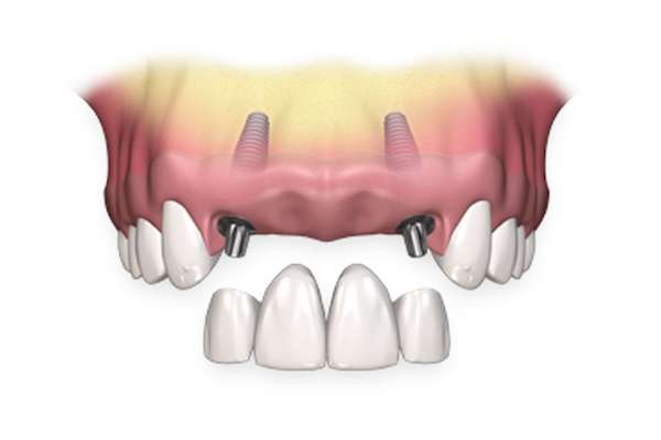 4 dents de devant cassees couronne