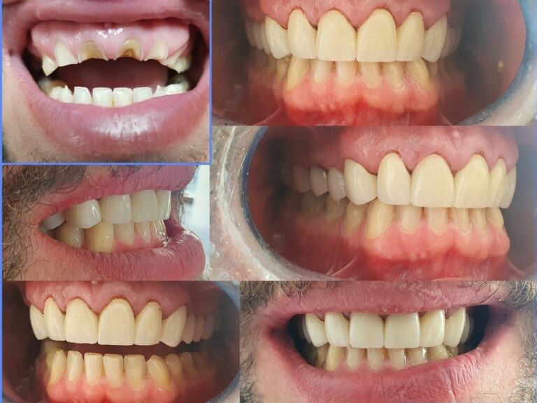 Restauration 4 dents de devant, pose de couronne Tunisie Guide complet et prix