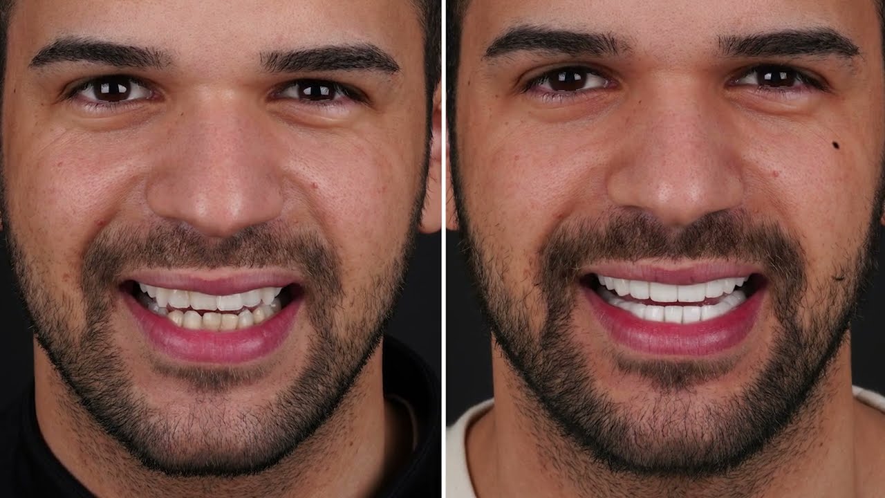 hollywood-smile-homme