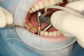 implant dentaire + greffe sinus