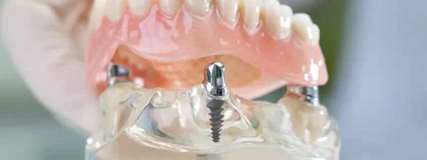 remplacement implant dentaire prix tunisie