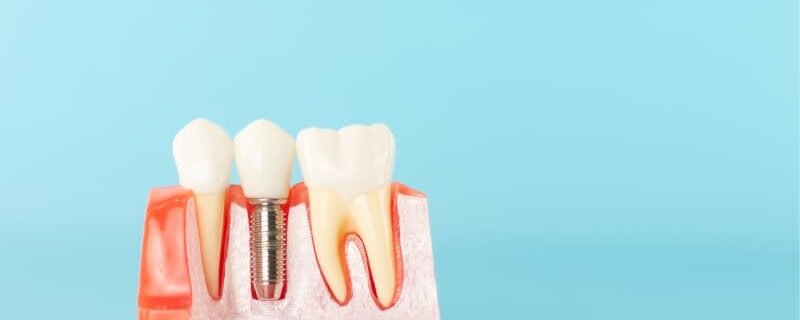 Prix implant dentaire unitaire tunsiie