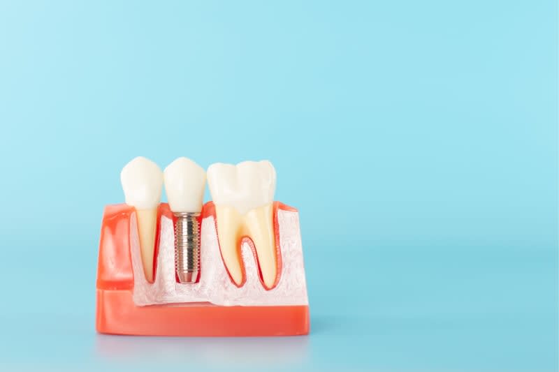 Prix implant dentaire unitaire tunsiie