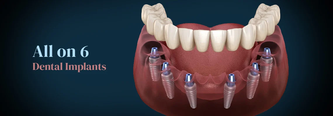 prix implants all on 6 tunisie