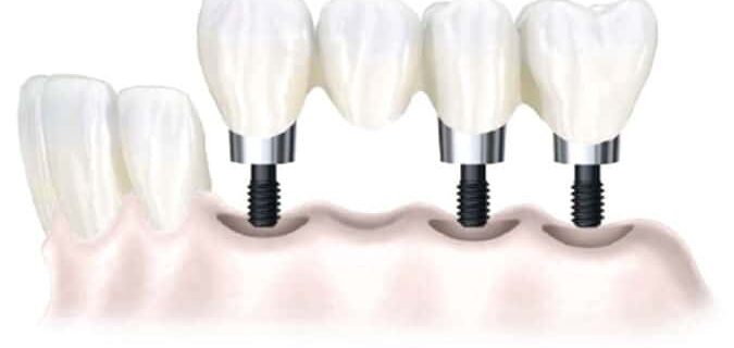 Pont sur implants dent manquante