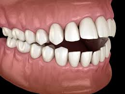 Traitement malocclusion dentaire