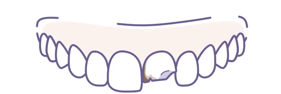 réparer les dents délabrées