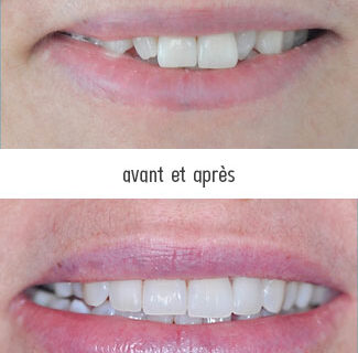 facette dentaire pour petite dent