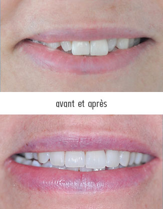 facette dentaire pour petite dent